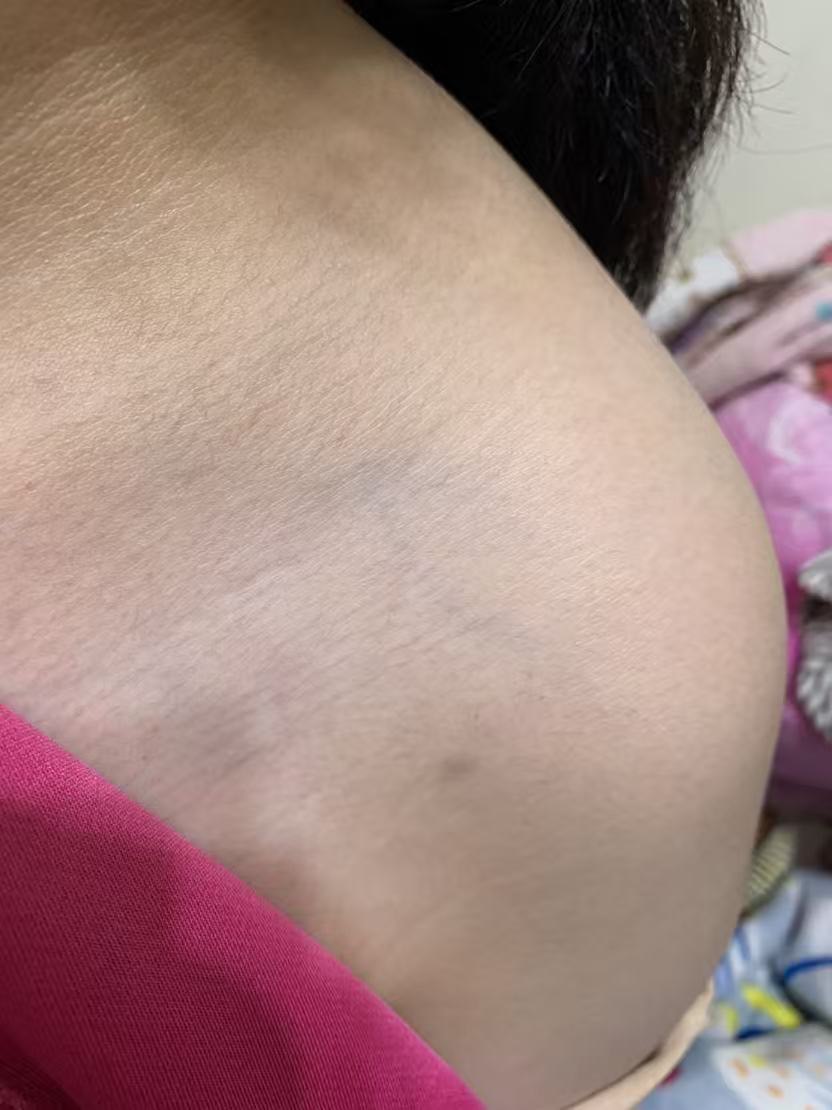 遭霸凌女學生身體多處部位遭毆瘀青。（圖：投訴者提供）