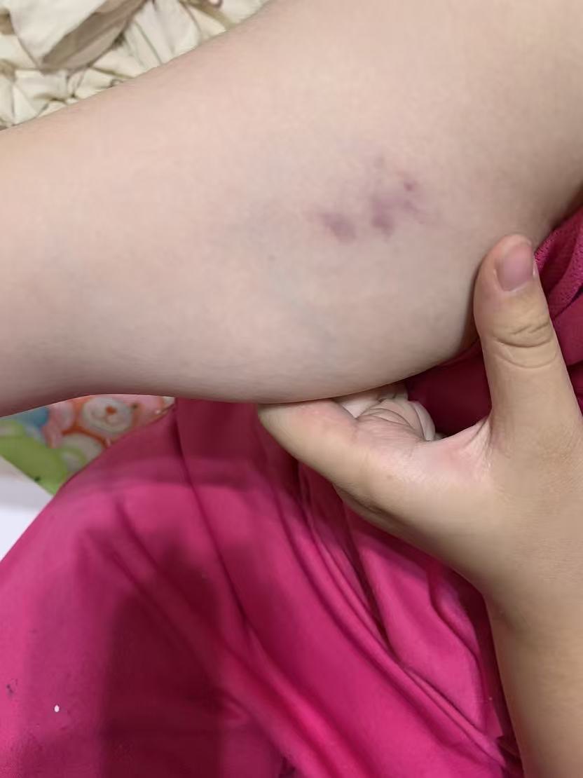 遭霸凌女學生身體多處部位遭毆瘀青。（圖：投訴者提供）