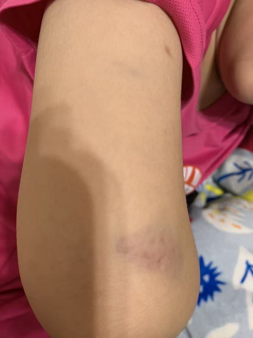 遭霸凌女學生身體多處部位遭毆瘀青。（圖：投訴者提供）