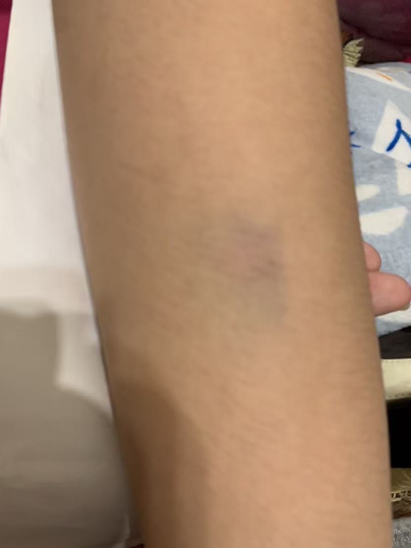 遭霸凌女學生身體多處部位遭毆瘀青。（圖：投訴者提供）